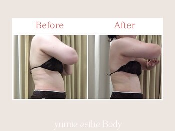 トータルビューティー ゆみえエステ(Total Beauty)/痩身/ハイパーナイフ ボディ