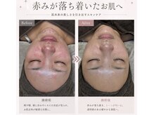 ビドウ(BIDOU)の雰囲気（お肌状態に合わせたオーダーメイド施術。）