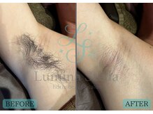 ルミナステラ(LuminaStella)/匠道ワックス+光脱毛☆脇