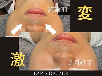 ラピスダズル(LAPIS DAZZLE)/ひげ脱毛☆途中経過