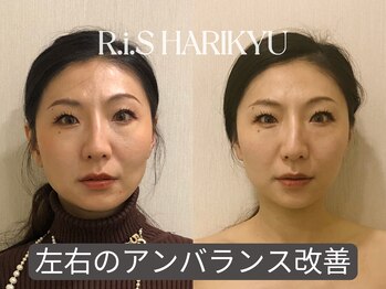 リス(R.i.S)/小顔矯正Before&After
