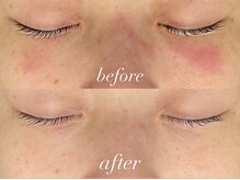 フェイン 青山店(fein.)/赤み撃退！！アンストレス