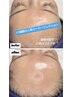 【目元のクマ・老化肌撃退】韓国最新技術スーパージェクション相談コース￥0