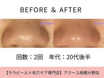 ア クーユ 相模大野店/毛穴洗浄/毛穴の黒ずみ/くすみ