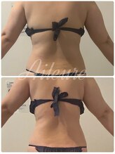 エルール トータルビューティ(Aileure total beauty)/インディバ痩身