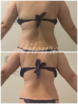 エルール トータルビューティ(Aileure total beauty)/インディバ痩身