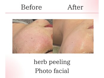 サロンツキ(salon tuki)/ハーブ×フォト症例