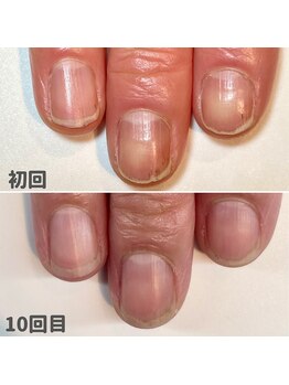 ココデネイル(cocode nail)/お悩み:割れ欠け、ささくれ