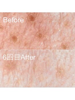 ミニョスキンラボ/韓国式ハーブピーリング6回