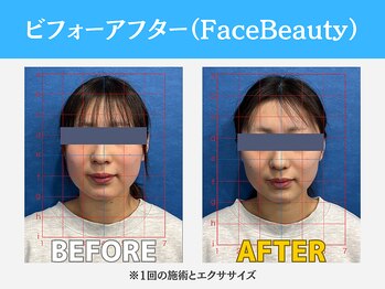 キャリッジスポーツ 盛岡(Carriage Sports)/ビフォーアフター【小顔】