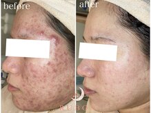 トータルビューティサロン ルボン(RUBON)/ニキビケア症例