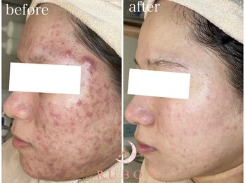 トータルビューティサロン ルボン(RUBON)/ニキビケア症例