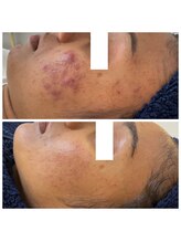 シファ(SHIFA)/ニキビ改善