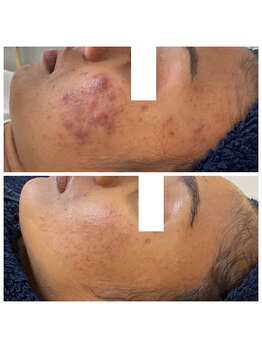 シファ(SHIFA)/ニキビ改善