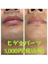 リアンジュ/ヒゲ脱毛の経過