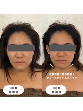 ウーマンビーヘルス(woman Be Health)/オーダーメイド美容鍼灸1回目