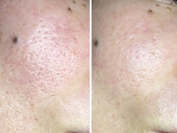 コハク(kohaku)/ララピール/ビフォーアフター