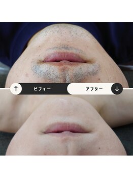ジュゴン(Dugong)/髭脱毛（Before＆After）