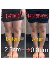 クシロ鍼灸整骨院/【O脚矯正】施術例