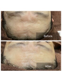 ハピエスト 御坊店/水光肌ピール