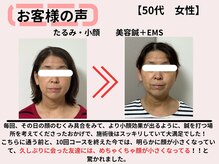 サロンスマイル/50代美容鍼ビフォーアフター