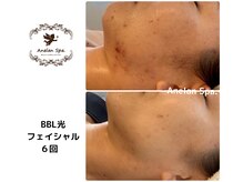アネランスパ(Anelan Spa.)
