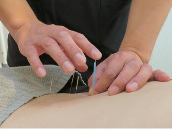 いこい鍼灸院 整骨院 小倉院/中国鍼灸施術