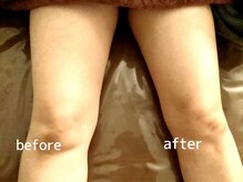 カレン/深層筋膜リリース