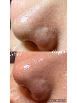 ウォーム(Warm)/40代女性毛穴エクストラクション