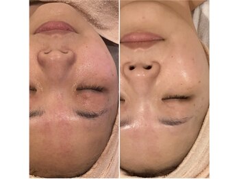 トータルエステティック ジョワイユ(JOYEUX)/肌改善！プラズマゼノデュアル