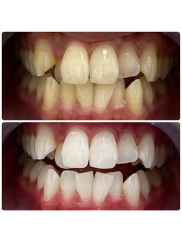 エクシアホワイトニング 日本橋店/ホワイトニング