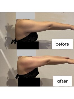 東京デトックス/【B→A】二の腕造形燃焼強炭酸