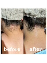 ゆいまーるはうす/うなじ脱毛