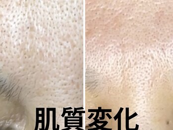 コハク(kohaku)/ララピール+美容液導入で◎