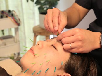 ハリング(HARIING)の写真/【電気を流す美容鍼で実現】鏡を見るのが、ちょっと楽しみになる。鍼で整う、スッキリ小顔と透明感♪