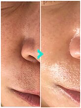 ミルキー(Milky)/マツヤニxクレイで毛穴レスへ