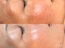 シェステ ゴジュウヨン(shesthe54)/症例写真|赤ら顔