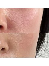 ウイユ(Oeil)/酸の不使用も可能！【効果1回】