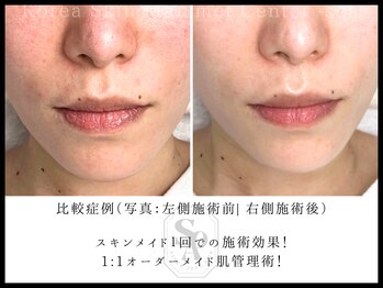 韓国肌管理室 ソア(soa)/【before&after】スキンメイド
