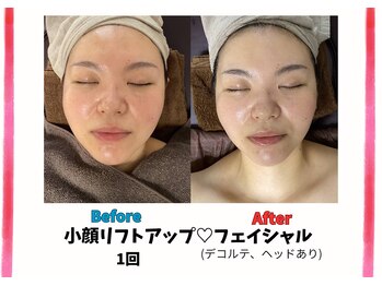 チャルメ/デコルテ小顔ヘッド【1回】