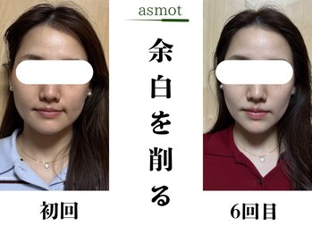 asmot鍼灸 整体院 代々木上原(asmot鍼灸 整体院)/★頭痛、食いしばりに効く美容鍼