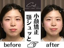 クレスト(CREST)/ビフォーアフター【小顔名古屋】