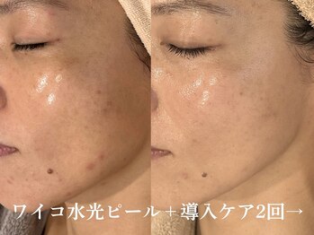 シュリー(Sriii)の写真/【年齢肌ケアに◎シミ改善・毛穴レス・リフトUP】ワイコ水光ピール×ビタミン導入