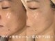 シュリー(Sriii)の写真/【年齢肌ケアに◎シミ改善・毛穴レス・リフトUP】ワイコ水光ピール×ビタミン導入