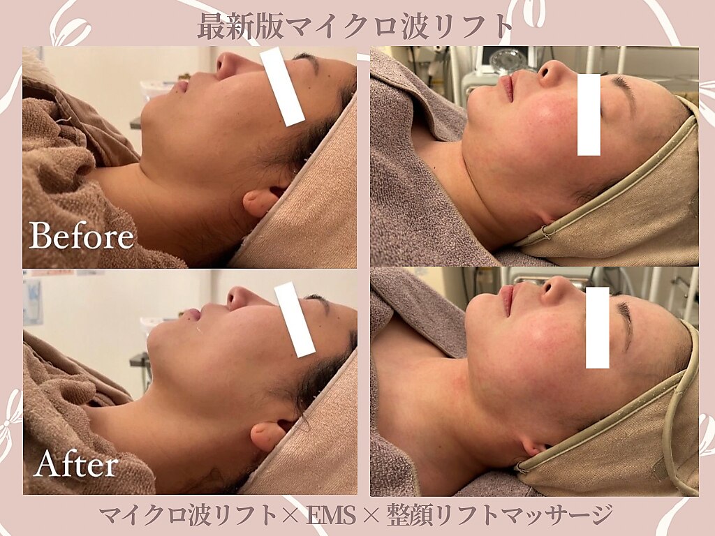 2ページ目｜水玉リフティング 大阪に関するエステサロン 【10年先も