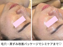 プリュボーテ(Pul Beaute)の雰囲気（毛穴に効果的なプラズマを使用。毛穴を小さくし皮脂コントロール）