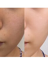 ジュエッテ(jouete)/シーナジーピール