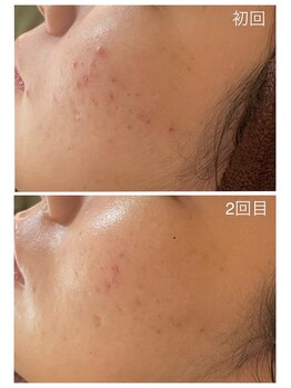 グリンプラス(grin+)/ハーブピーリング/フェイシャル