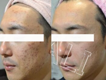 パトラ 難波店/ハーブピーリング★ニキビケア