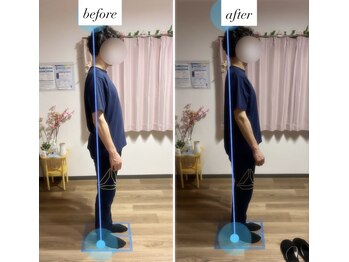 カラダリリース 浜松店/反り腰、胸椎フラットバック改善